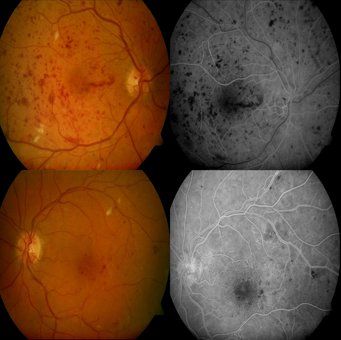 Diabetic Eye Disease