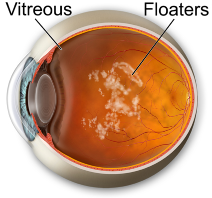 Treatment of Floater